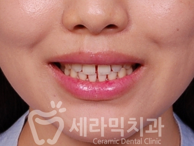 벌어진 앞니, 치아 사이 공간 교정 잘하는 세라믹치과 관련 이미지 2