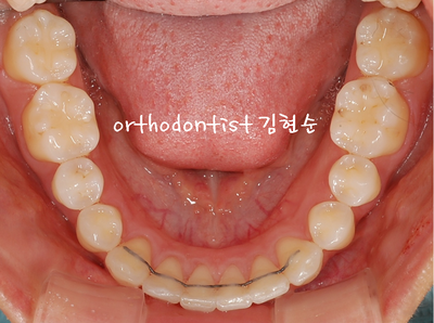 돌출 교정 (비발치 교정/비대칭) 관련 이미지 28
