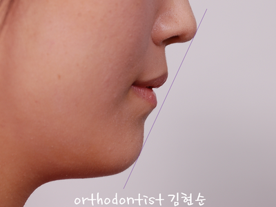 개방 교합 관련 이미지 12