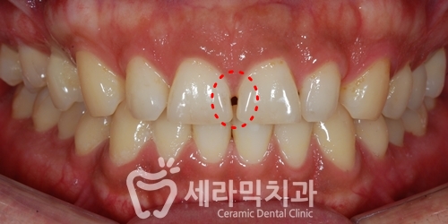 벌어진치아 투명교정 치아교정전후 관련 이미지 1