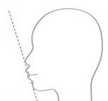 세라믹치과 돌출입교정 해결하기 관련 이미지 2