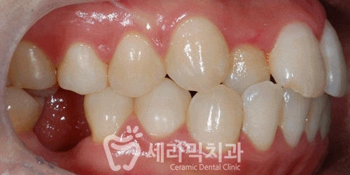 돌출입, 치열불규칙, 치아상실 치아교정과 임플란트 전후 관련 이미지 7