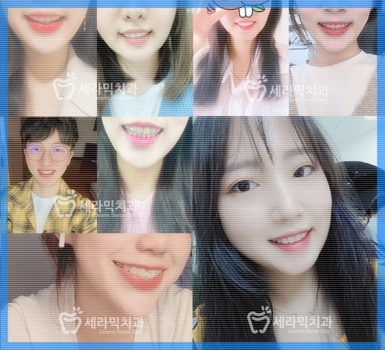 청소년교정 10대교정 딥바이트 과개교합 치아교정전후 관련 이미지 12