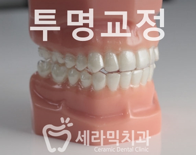 앞니 돌출, 나비치아를 남몰래 해결한 치아교정 전후! 관련 이미지 3