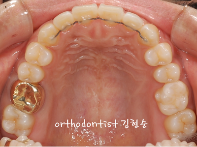 치열 교정 ( 벌어짐 ) 관련 이미지 23