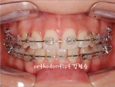 강남치아교정추천 관련 이미지 15