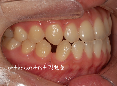 반대 교합 관련 이미지 9