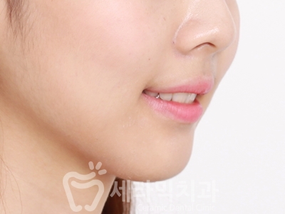 과개교합 치아교정잘하는곳, 세라믹치과 치아교정전후! 관련 이미지 24