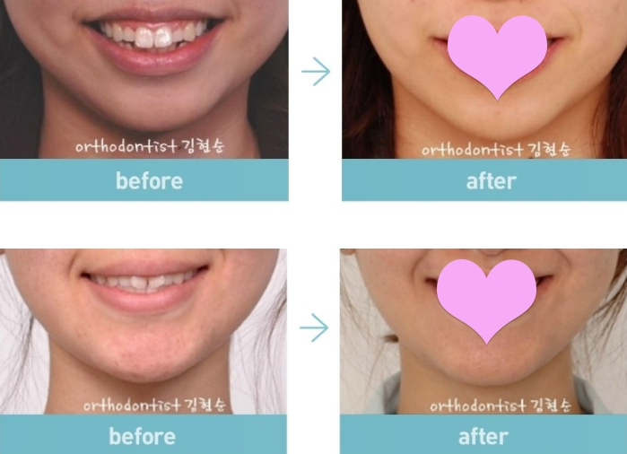 비발치교정 스트리핑이 필요 관련 이미지 6