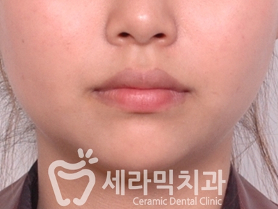 토끼이빨, 틀어진 치아배열 세라믹교정 전후사진 관련 이미지 2