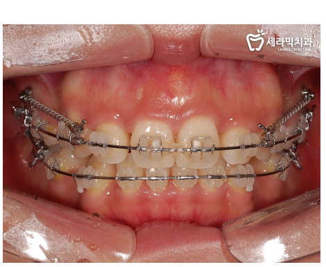 학동역 돌출입교정 세라믹치과 관련 이미지 5