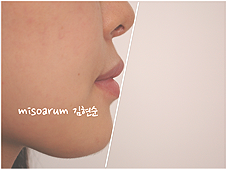 강남 돌출입 교정 관련 이미지 20