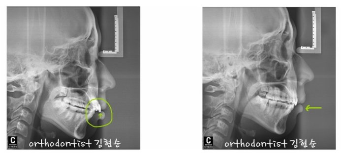 강남 돌출입 관련 이미지 7