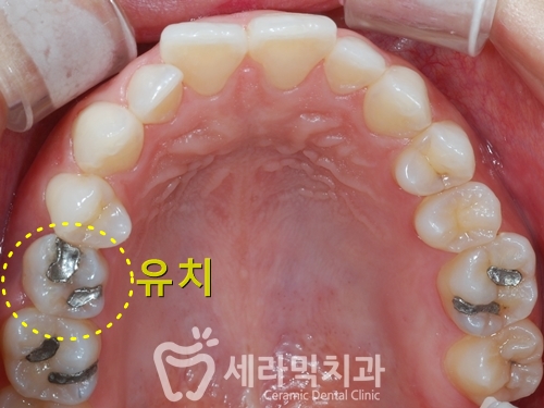 나비치아, 앞니돌출, 과개교합 치아교정전후 관련 이미지 1