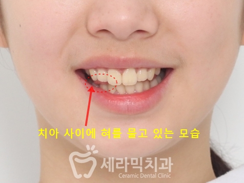 돌출입교정, 심미성과 치아 건강을 동시에 해결! 관련 이미지 4