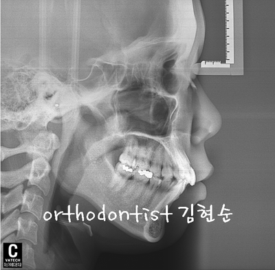 강남 돌출 관련 이미지 5