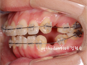 세라믹교정 은 관련 이미지 6
