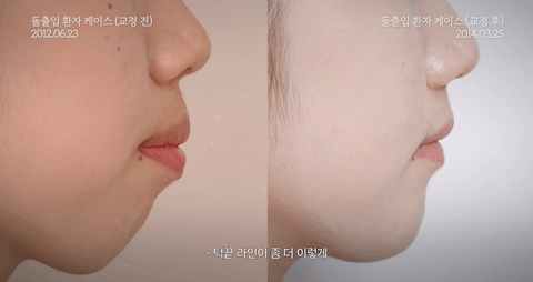 돌출입 교정 기간은 얼마나 걸릴까? 관련 이미지 5