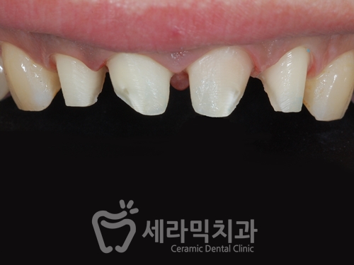 무삭제라미네이트 , 세라네이트가 궁금하다면? 관련 이미지 1