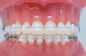 데이몬클리어 vs 클리피씨교정 관련 이미지 3