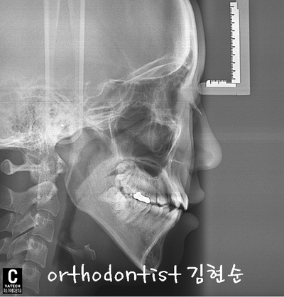 치열 교정(치열 불규칙) 관련 이미지 14