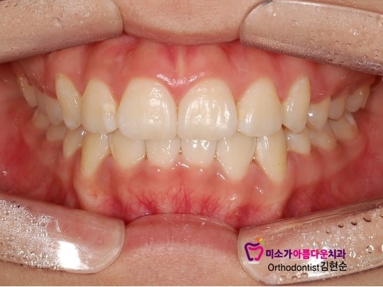 논현동교정잘하는치과 미소가아름다운치과 고객님 후기입니다 관련 이미지 2