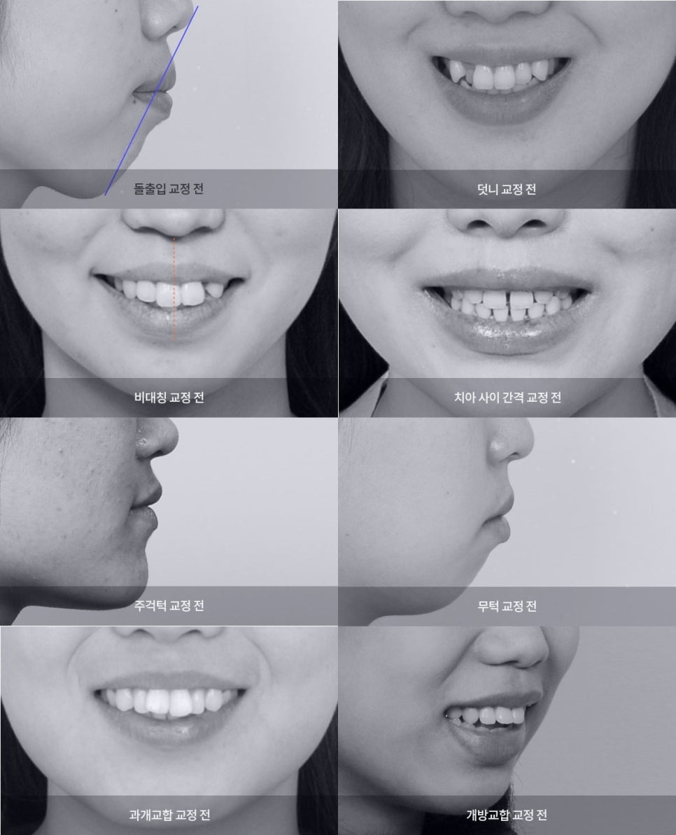성공적인 치아교정은 치아교정 전문의에게! 관련 이미지 1