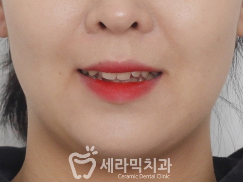 삐뚤빼뚤 치열불규칙 치아교정전후 달라진 미소 관련 이미지 3