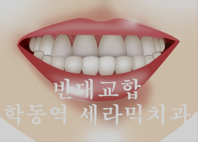 주걱턱 비수술 치아교정 잘하는 학동역 세라믹치과 관련 이미지 4