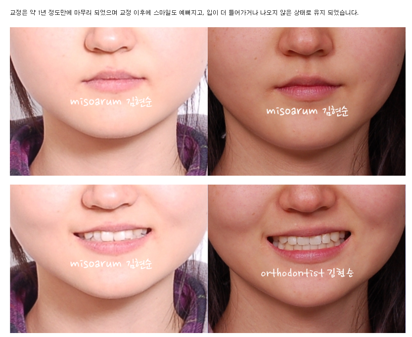치아의 배열을 개선, 발치하지 않고 교정하기 관련 이미지 7