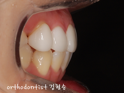 강남 덧니, 돌출 관련 이미지 25