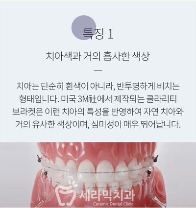세라믹치과에서 세라믹교정이 인기있는 이유! 관련 이미지 6
