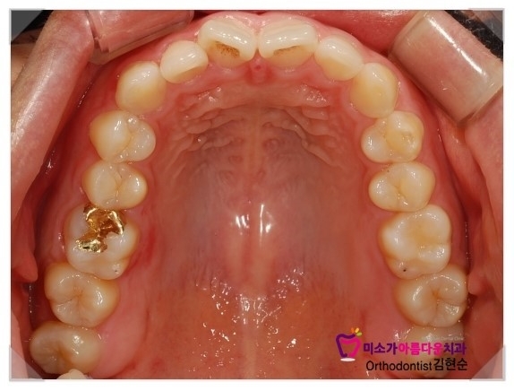 과개교합 교정 후기 세라믹교정치과 관련 이미지 3