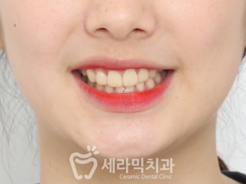 돌출입교정, 심미성과 치아 건강을 동시에 해결! 관련 이미지 21