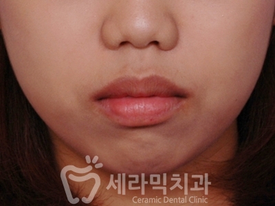돌출입과 개방교합 치아교정 치료전후 관련 이미지 2
