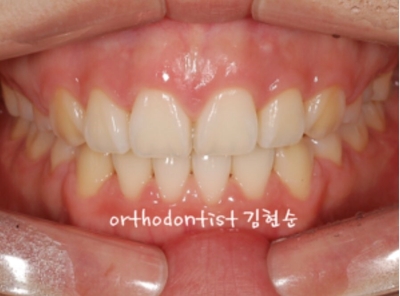 강남치아교정추천 관련 이미지 16