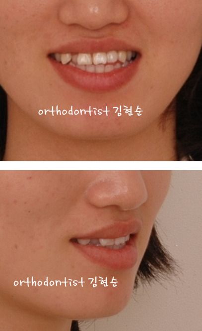 안면비대칭 교정, 치아교정만으로 간단히 해결하기 관련 이미지 5