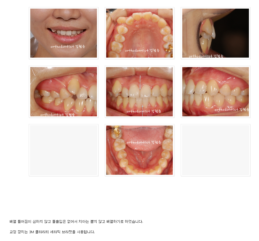 비발치로 덧니의 치열을 개선, 중심선을 맞추는 교정. 관련 이미지 2