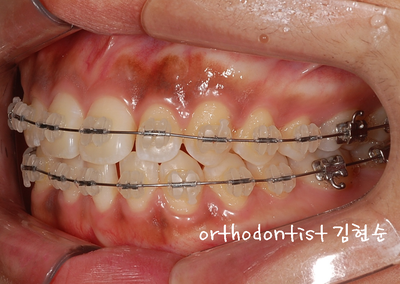 치열 교정 ( 벌어짐 ) 관련 이미지 17