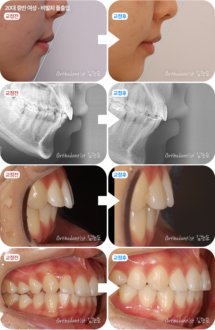 돌출입 비발치 치아교정 관련 이미지 7