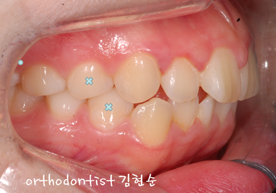 강남 돌출 관련 이미지 16