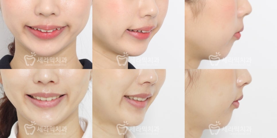 앞니 돌출, 개방교합으로 치아교정을 시작했는데, 작았던 아래턱이 커졌어요! 관련 이미지 18