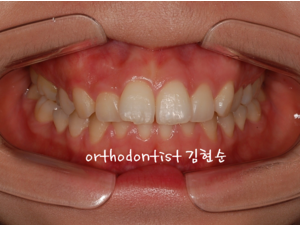 강남 돌출입 교정 관련 이미지 6
