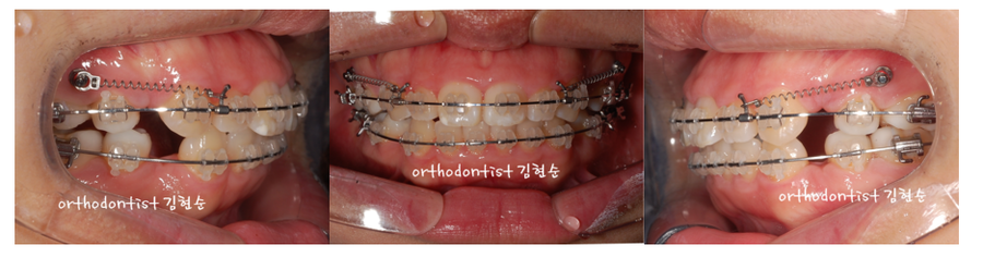 미니스크류, 돌출입 발치 교정 잇몸노출 개선 관련 이미지 10