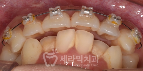 Before and After Orthodontic Treatment for Protruding Mouth and Deep Bite: A Calmer, More Sophisticated Transformation! image 5