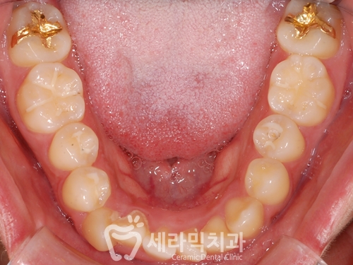 돌출입교정으로 갸름한 턱라인까지 되찾다! 돌출입 치아교정전후 관련 이미지 14