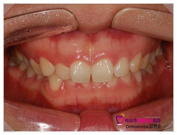 과개교합 교정 후기 세라믹교정치과 관련 이미지 1