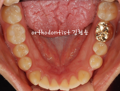 반대 교합 관련 이미지 8