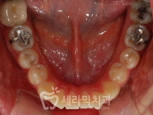 앞니 돌출, 개방교합으로 치아교정을 시작했는데, 작았던 아래턱이 커졌어요! 관련 이미지 10