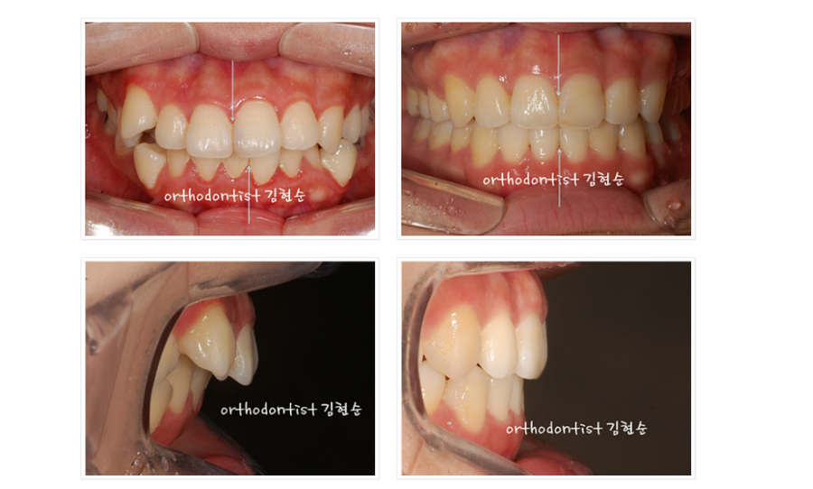 돌출입 발치교정, 미니스크류를 통한 6가지 변화 관련 이미지 13